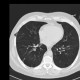 Lung hernia, centrilobular emphysema: CT - Computed tomography